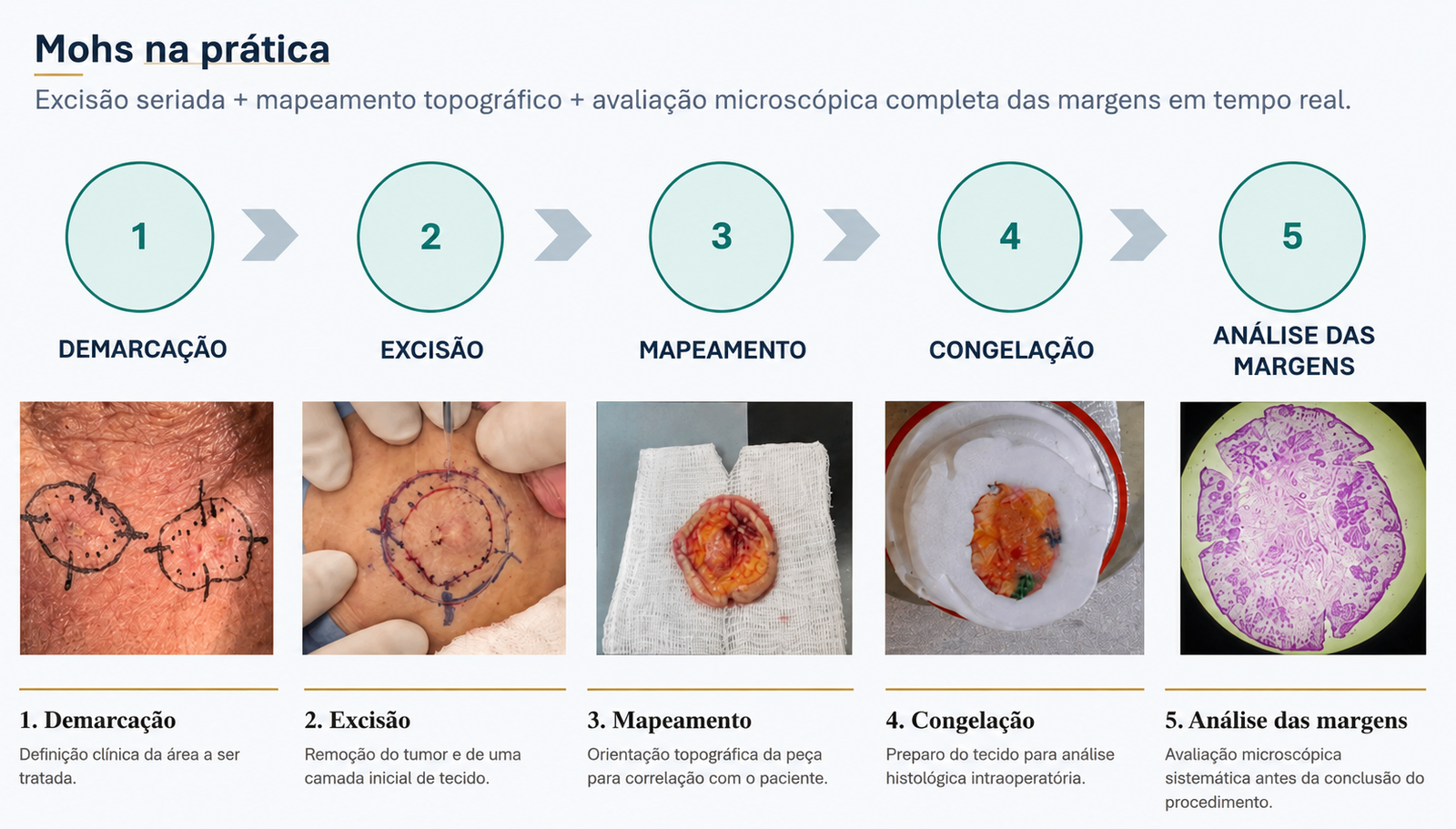 Mohs na prática: demarcação, excisão, mapeamento, congelação e análise das margens